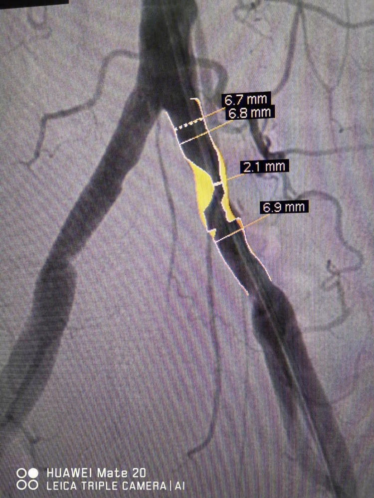 髂动脉支架图片
