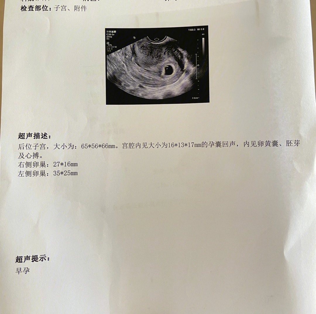 怀孕45天的彩超图片图片