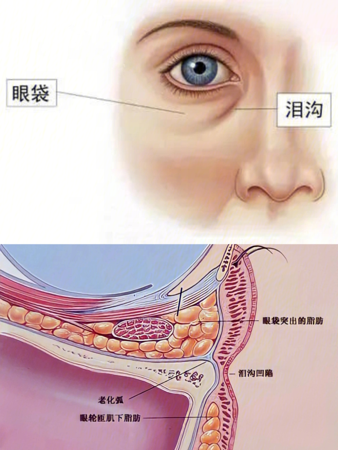 泪沟型眼袋形成的原因图片