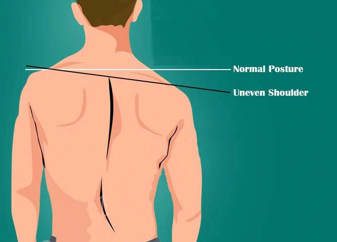 1,两侧肩胛骨冠状面和水平面上的位置偏移2,肩胛骨不对称就导致肩膀