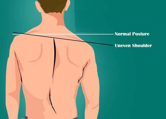 左右肩胛骨不对称图片图片