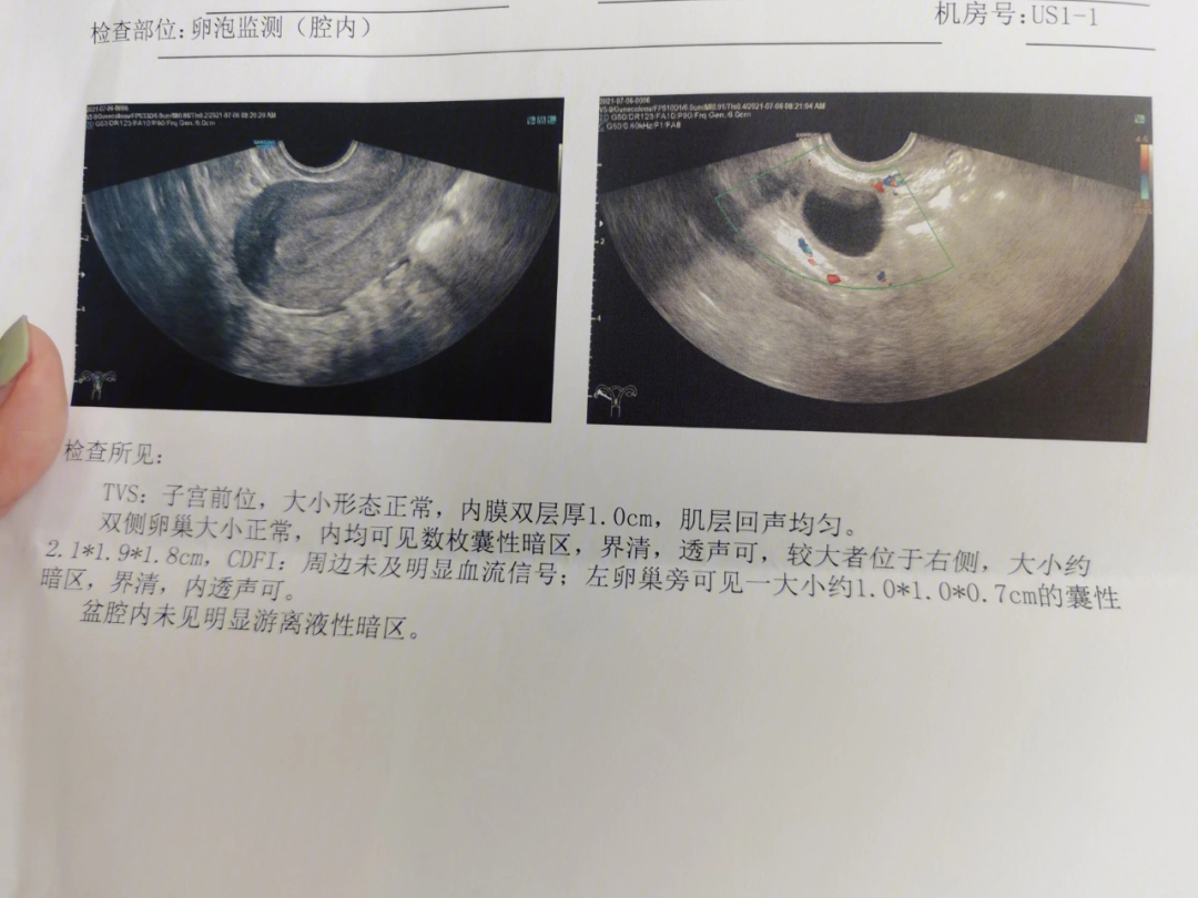 胎停后备孕之卵泡监测二