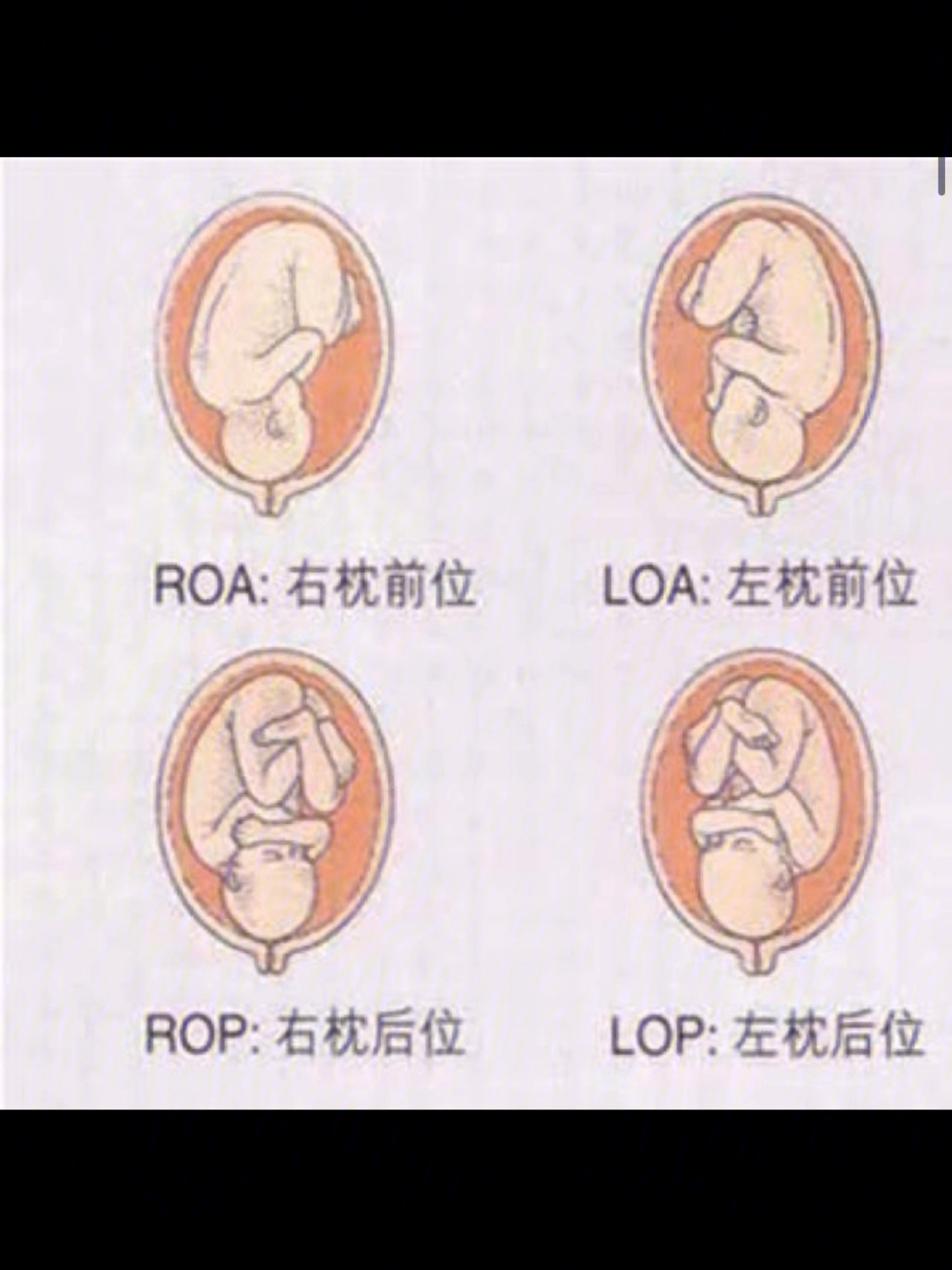 胎位rsa显示图图片