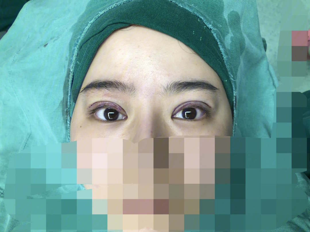 术后双眼皮恢复过程图图片