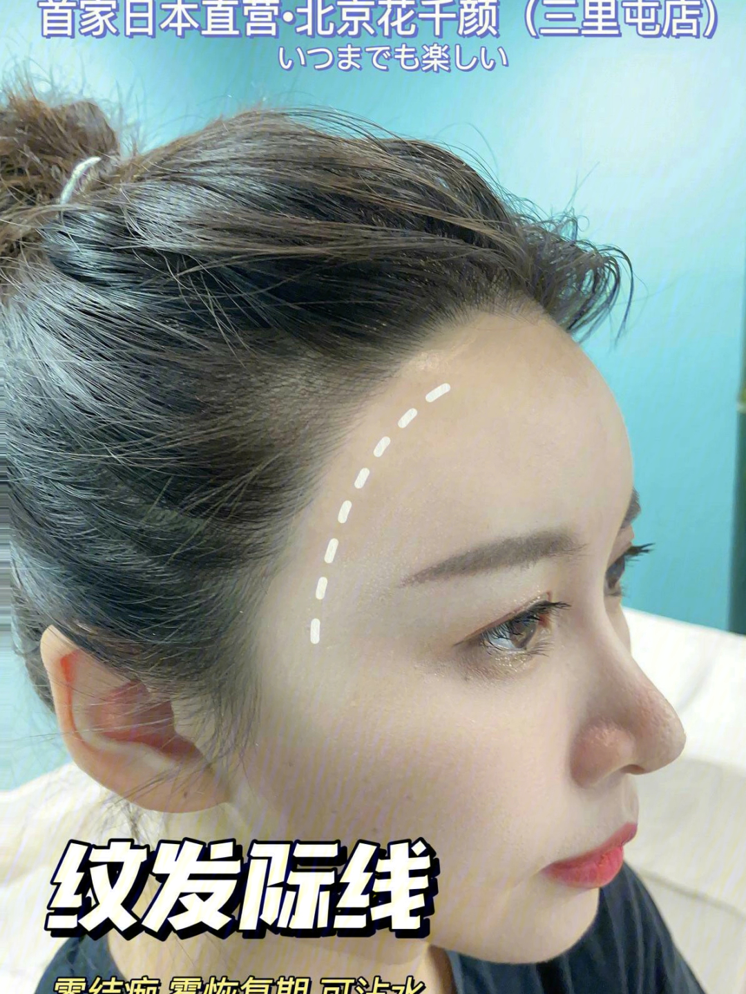 北京纹眉纹发际线