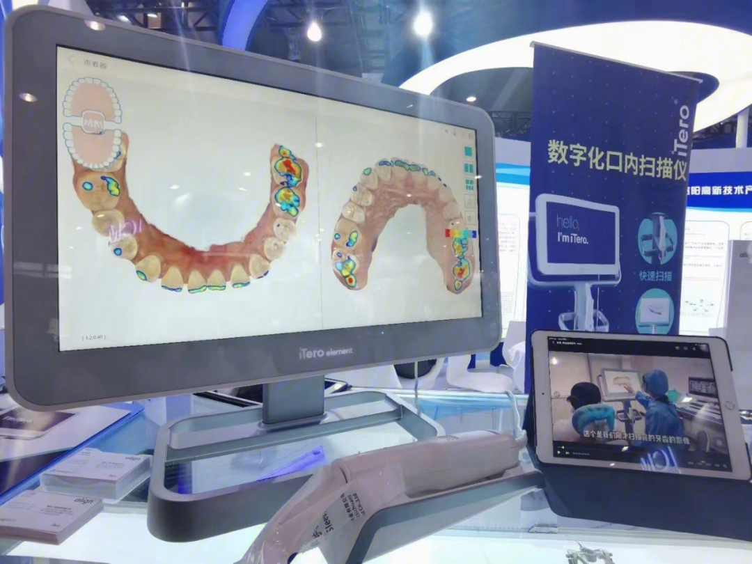 itero口扫牙齿矫正黑科技