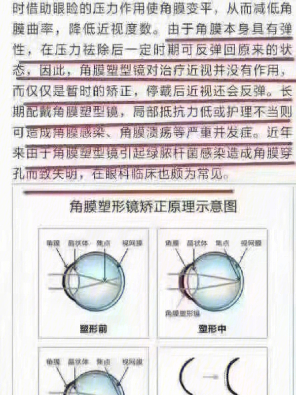 北京同仁眼科医生惊爆:角膜塑形镜的危害触目惊心!