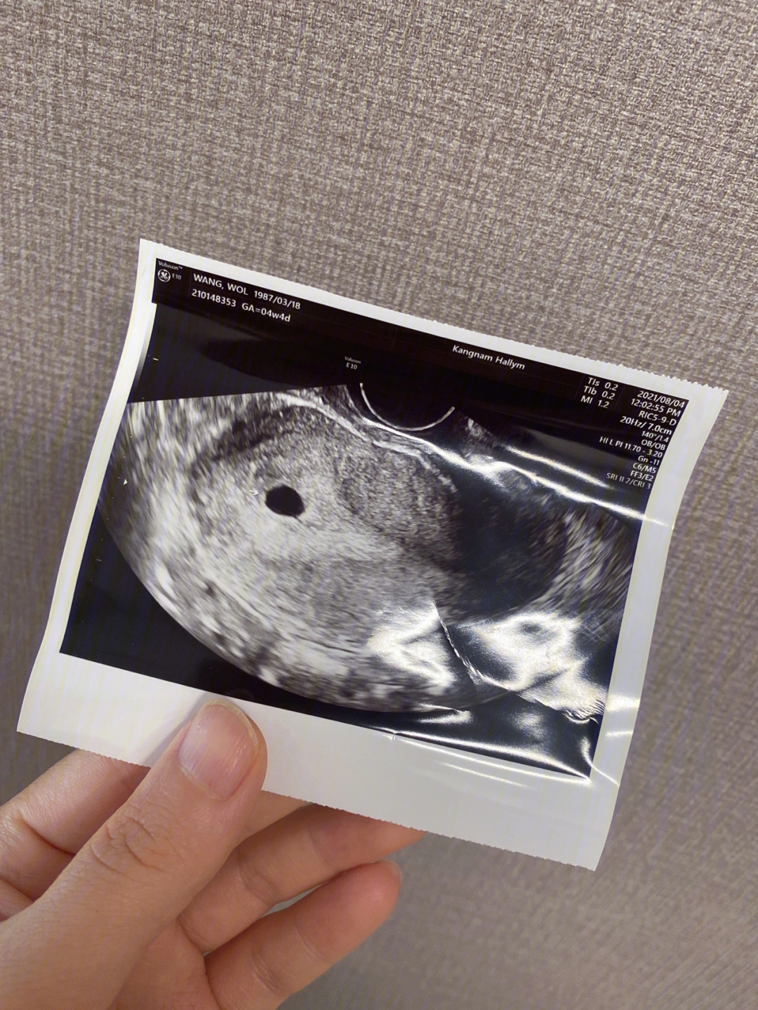 三周孕囊图片图片