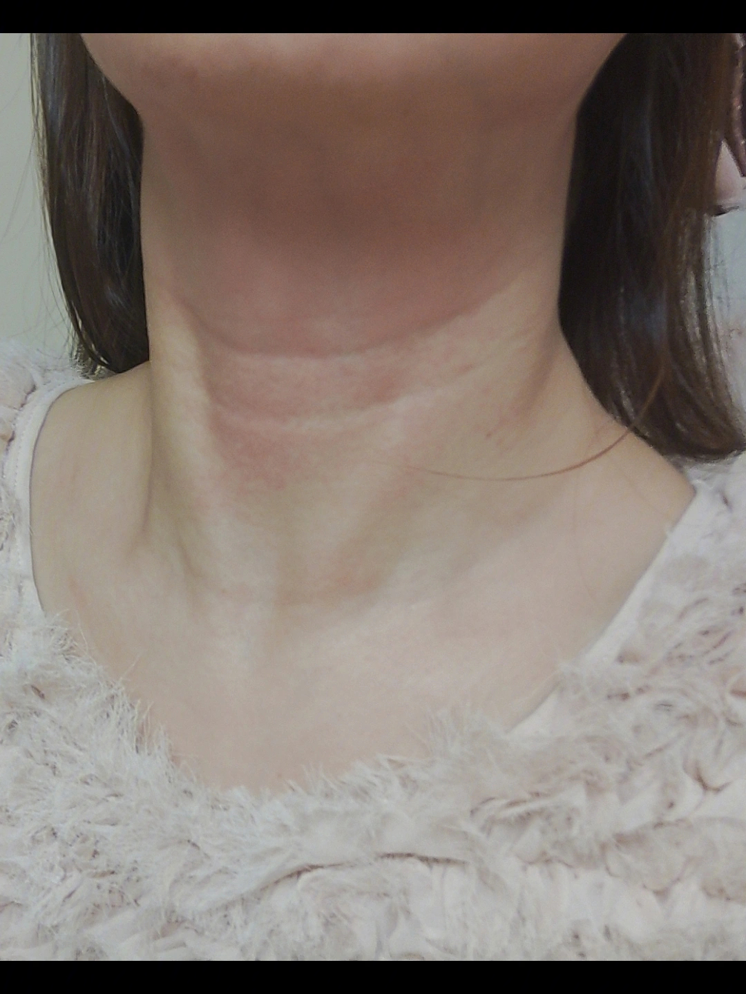 颈部吸脂手术前后图片图片