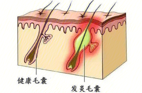 头皮上篇脱发问题解决头皮毛囊问题