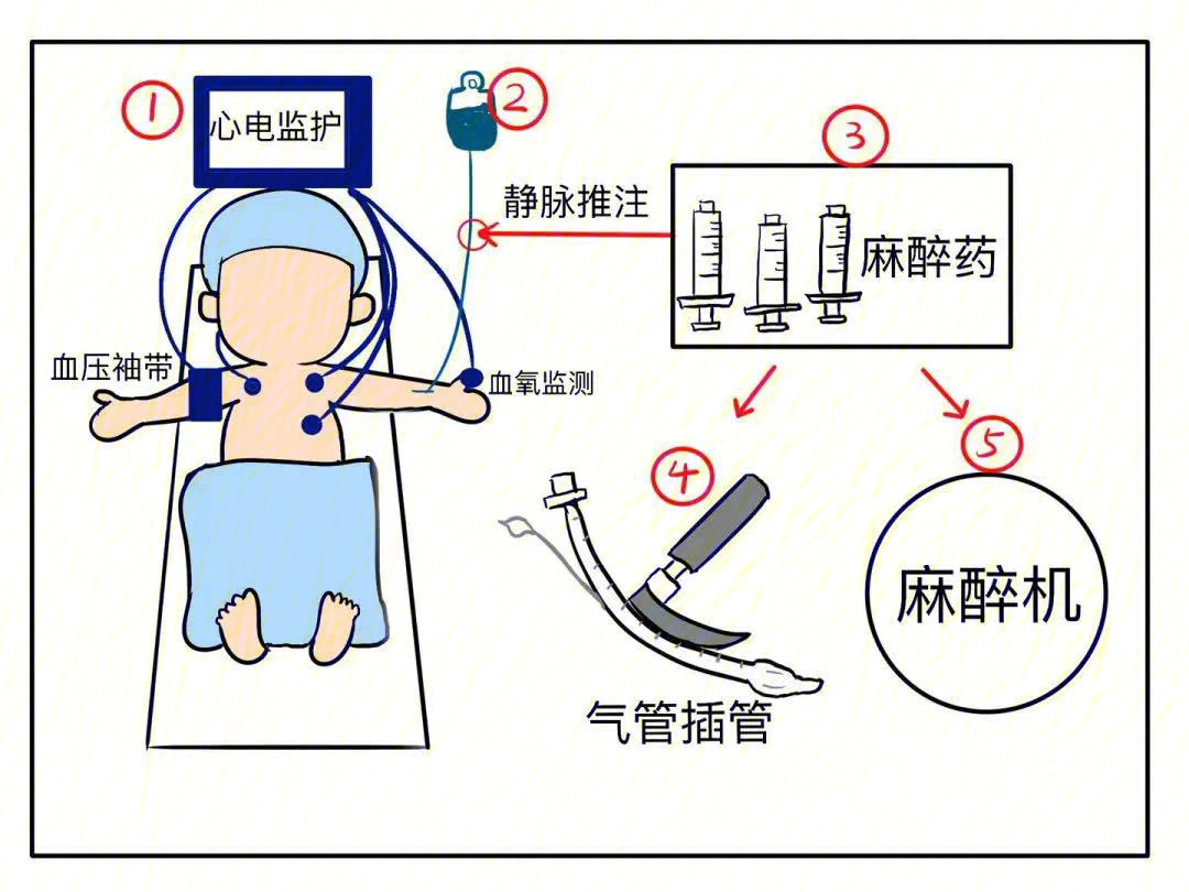 抽脂该选哪种麻醉全麻or局麻