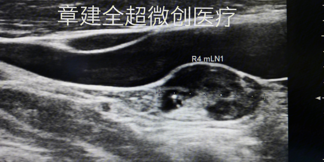 美国甲状腺协会指南总结了可疑转移性淋巴结的超声征象,包括:微钙化