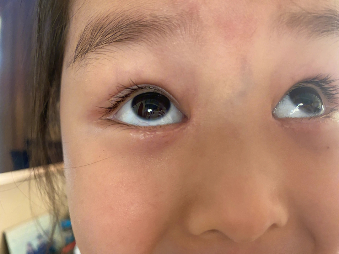 儿童倒睫手术前后图片图片