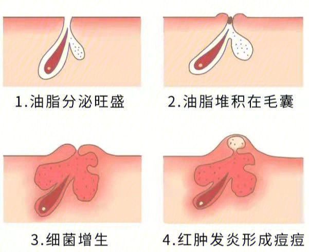 皮脂腺在皮肤哪一层图片