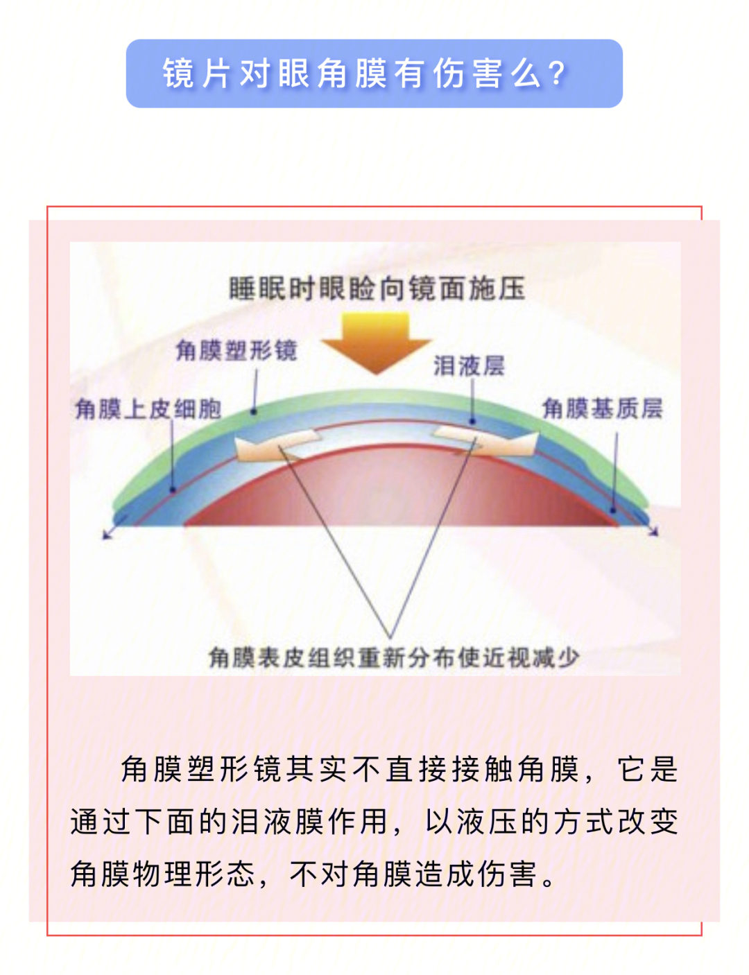 79ok镜对少儿控制近视真ok