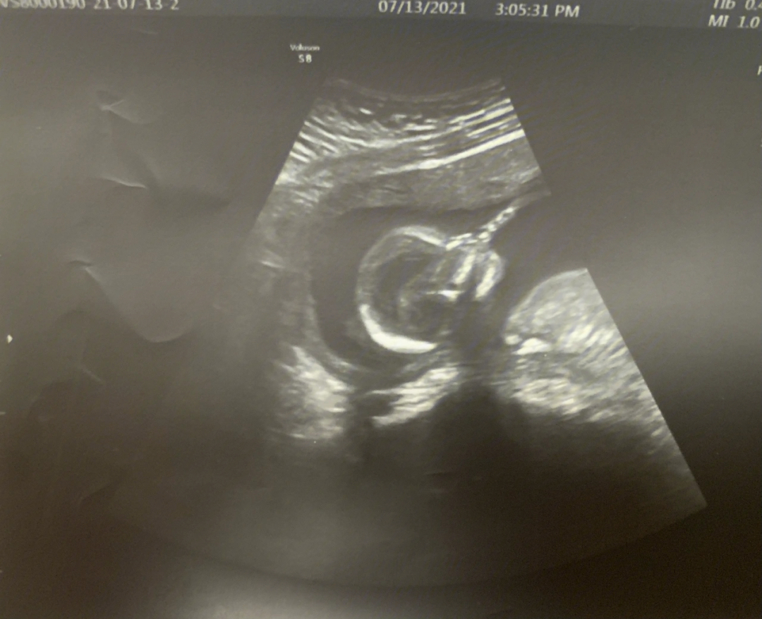 怀孕16周胎儿彩超图片图片