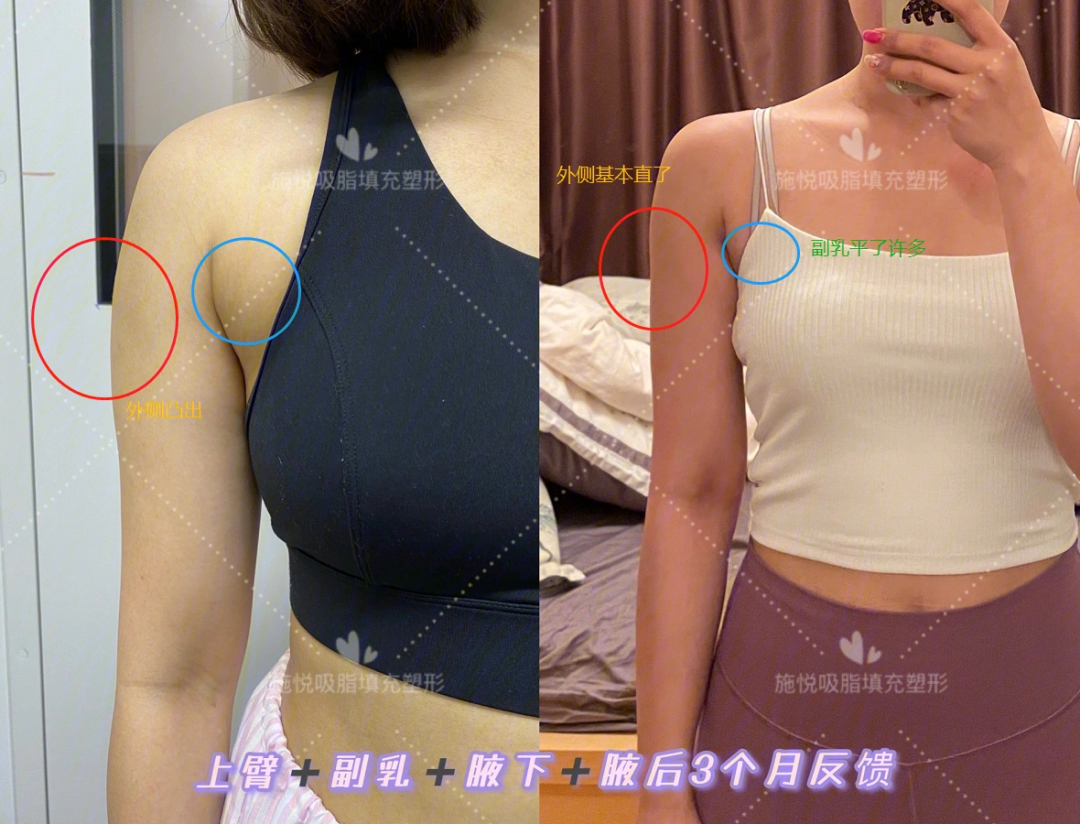 副乳手术吸脂前后图片图片