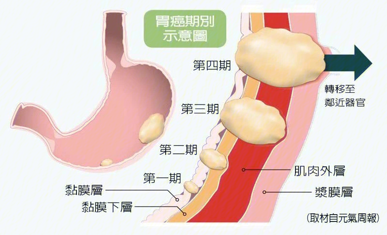 胃癌是怎么形成的图片