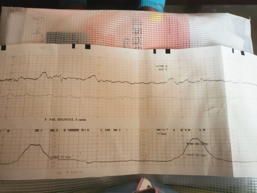 第一次胎心监护,看着有点吓人越到孕晚期,心情越焦虑啊