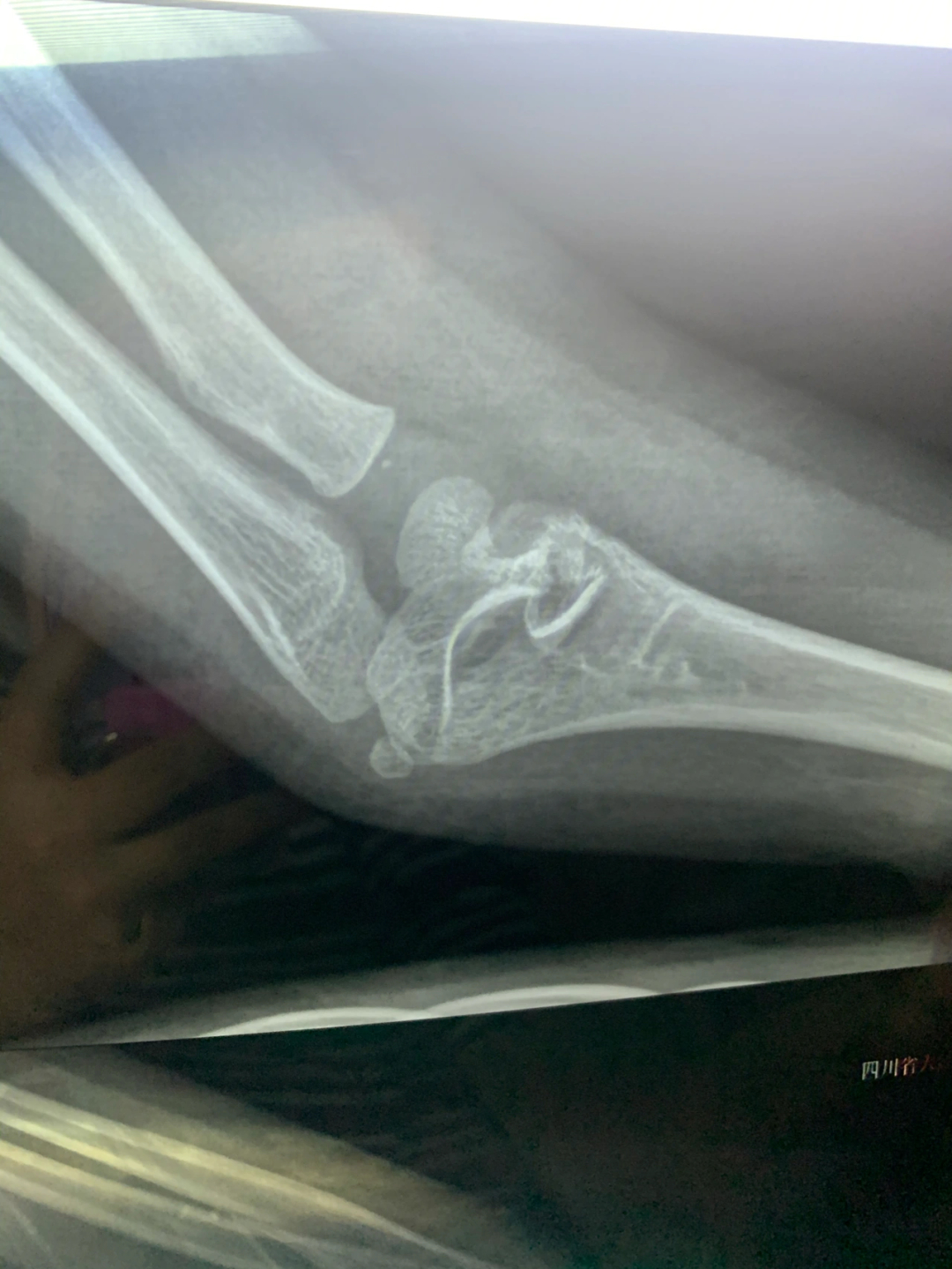 儿童右肱骨髁上骨折图片