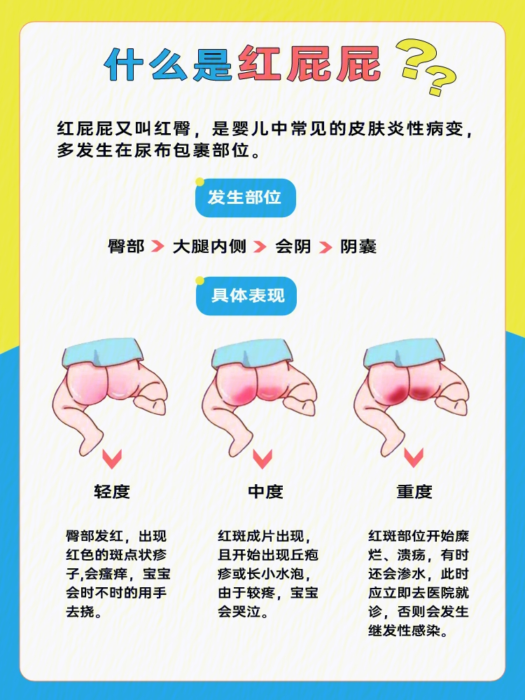 什么是红屁屁宝宝红屁屁了怎么办