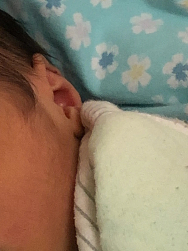 新生儿耳朵压扁怎么办图片