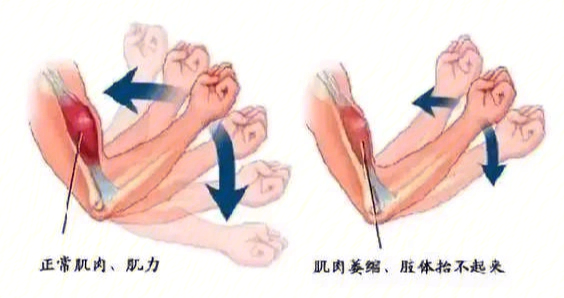 怎样判断自己肌肉萎缩图片