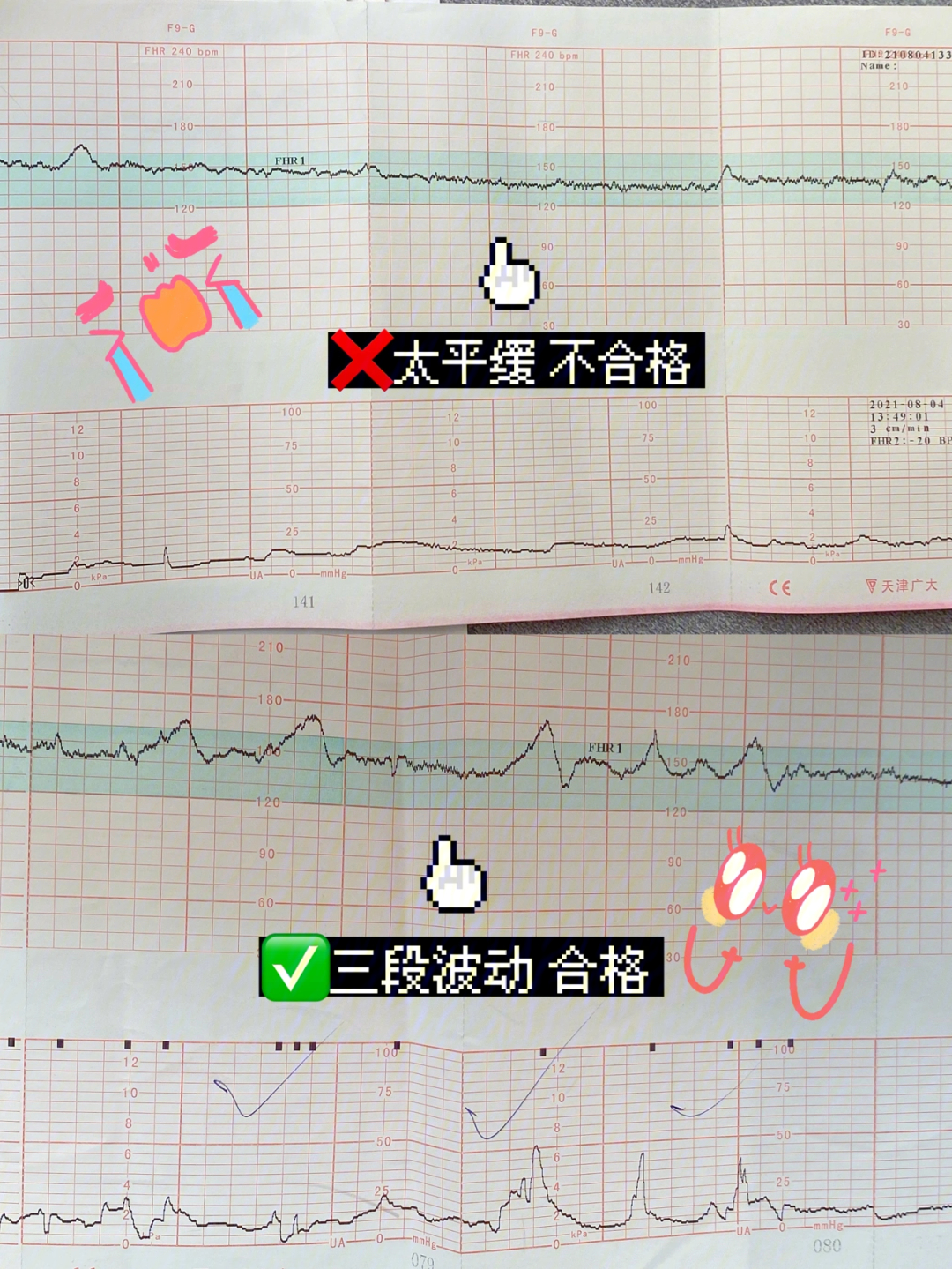 胎心监测怎么才算合格图片