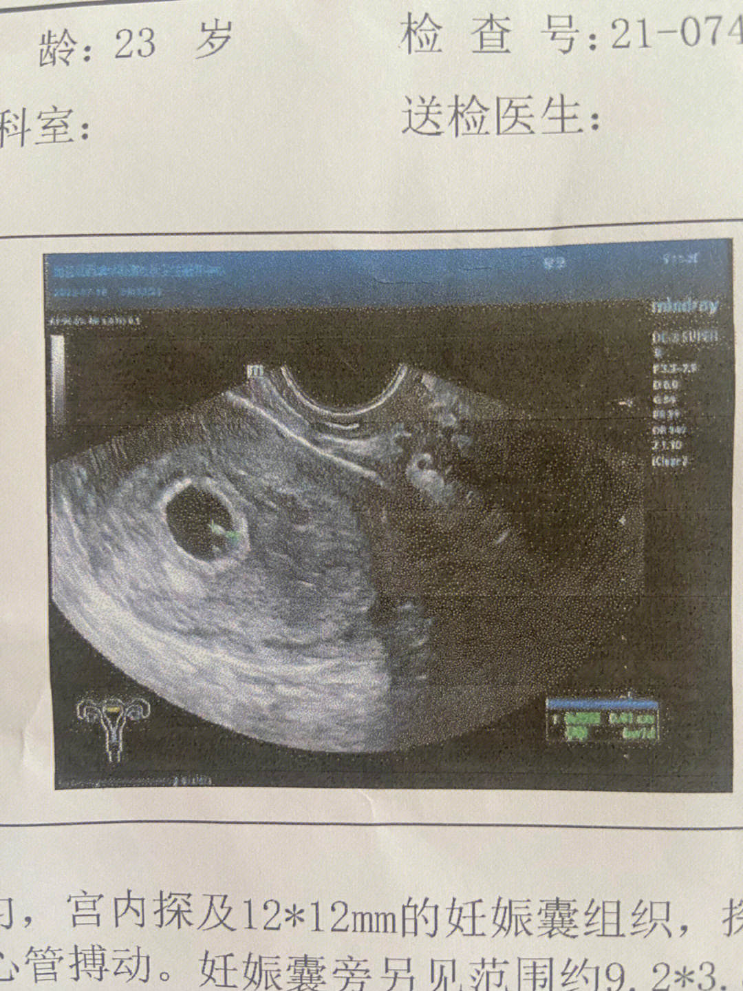 怀孕三十几天孕囊图片图片