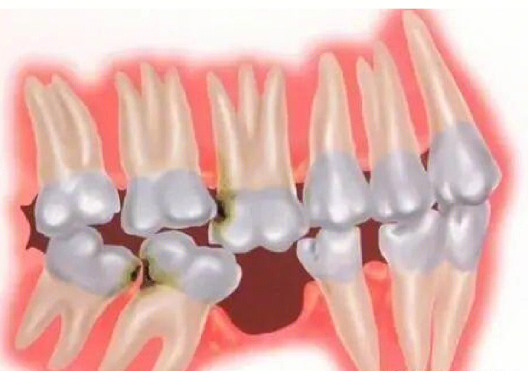 牙槽骨增生有什么危害图片