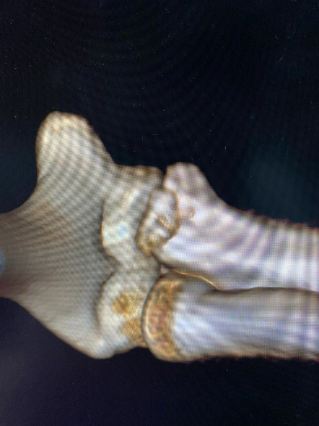 尺骨冠状突骨折图片