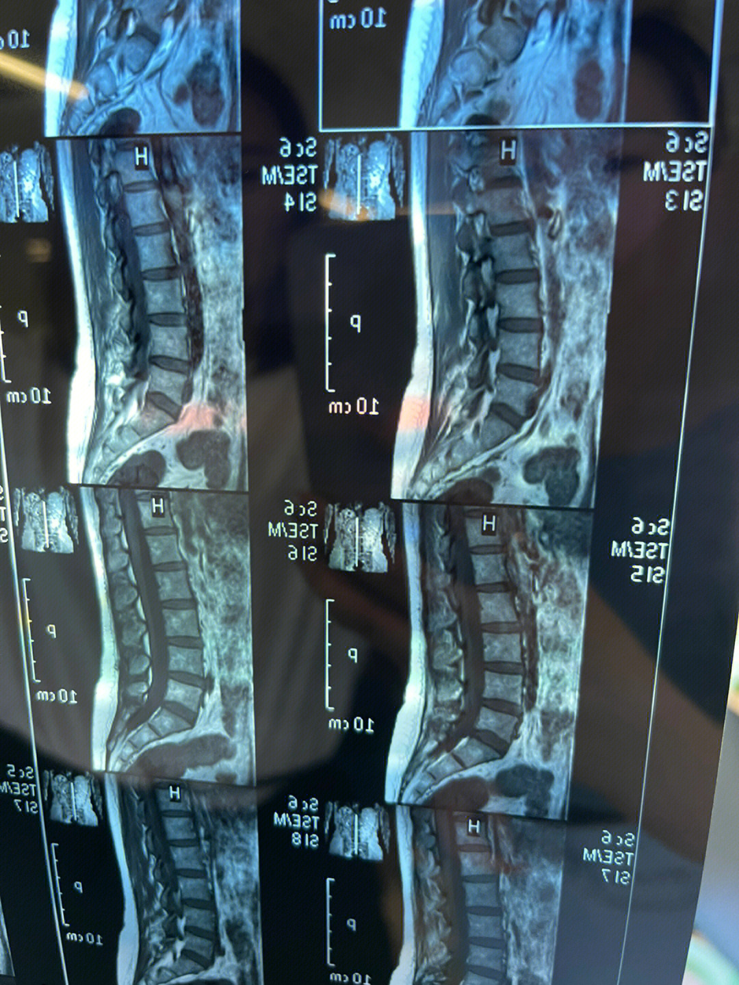 腰肌劳损x光片图片图片