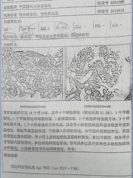 5g,肾穿刺iga肾病4级-5级,曾就诊宁夏医大总院及北大医院声称5年会