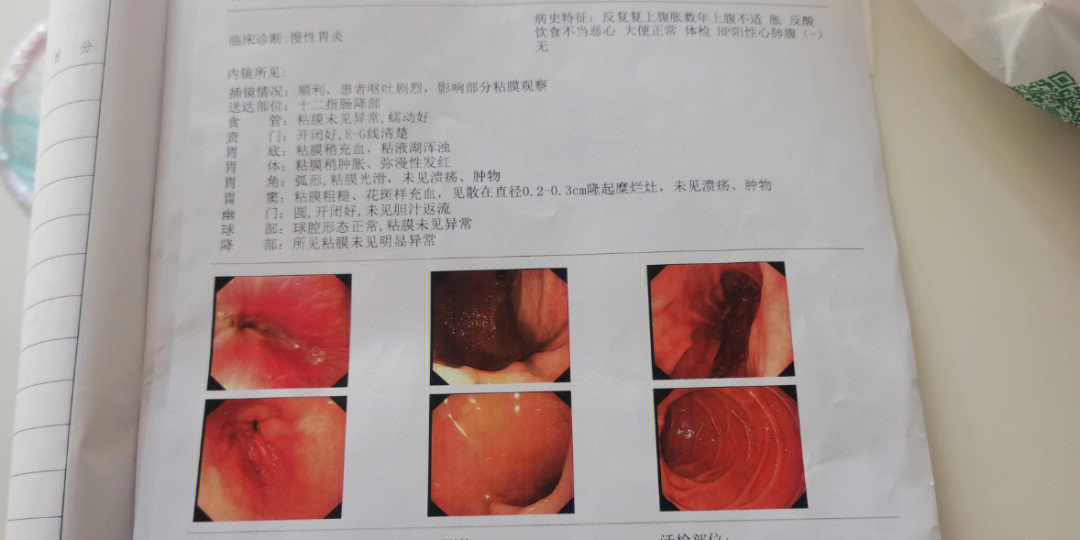 慢性非萎缩性胃炎伴糜烂