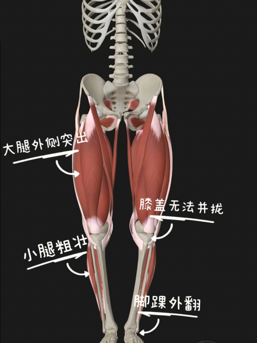 不良的走路姿势让大腿前侧代偿太多,股骨内旋,膝盖内扣,胫骨发生扭转