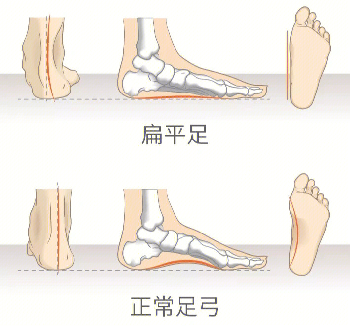 为什么扁平足一定要穿矫正足垫