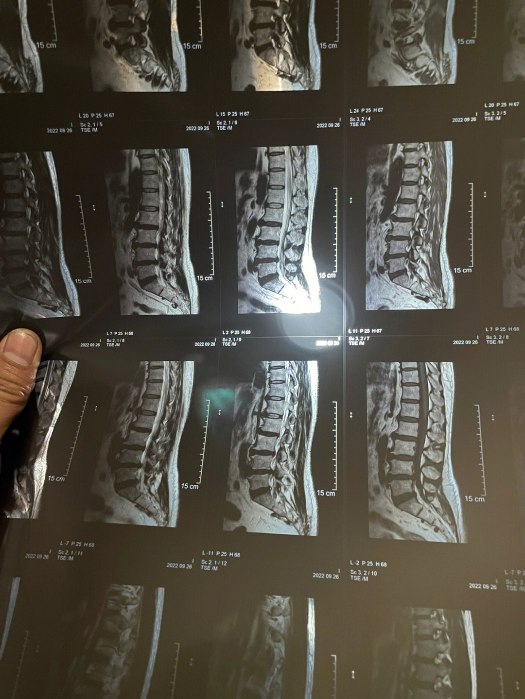 腰椎突出