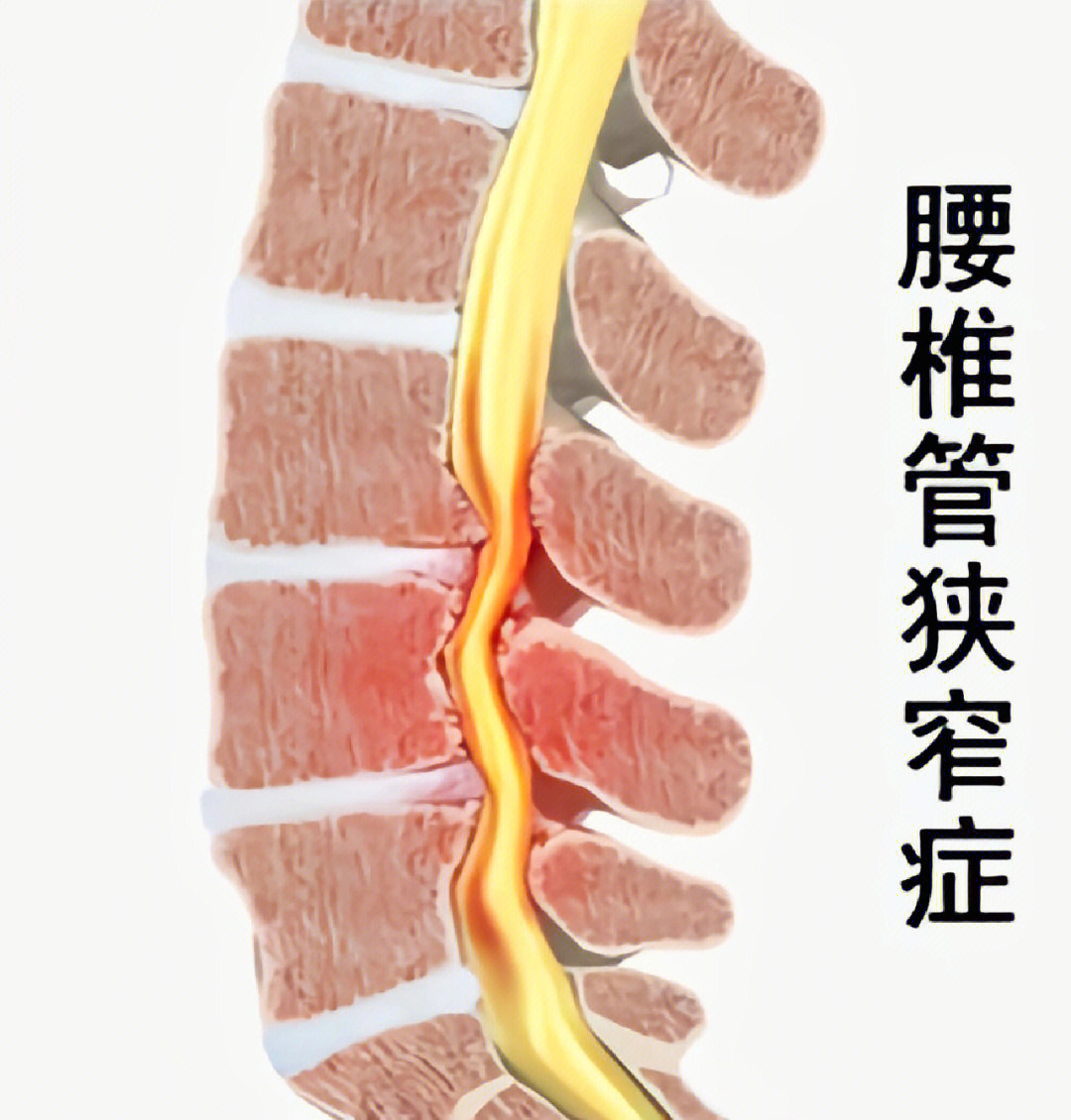 腰椎椎管矢状径图片