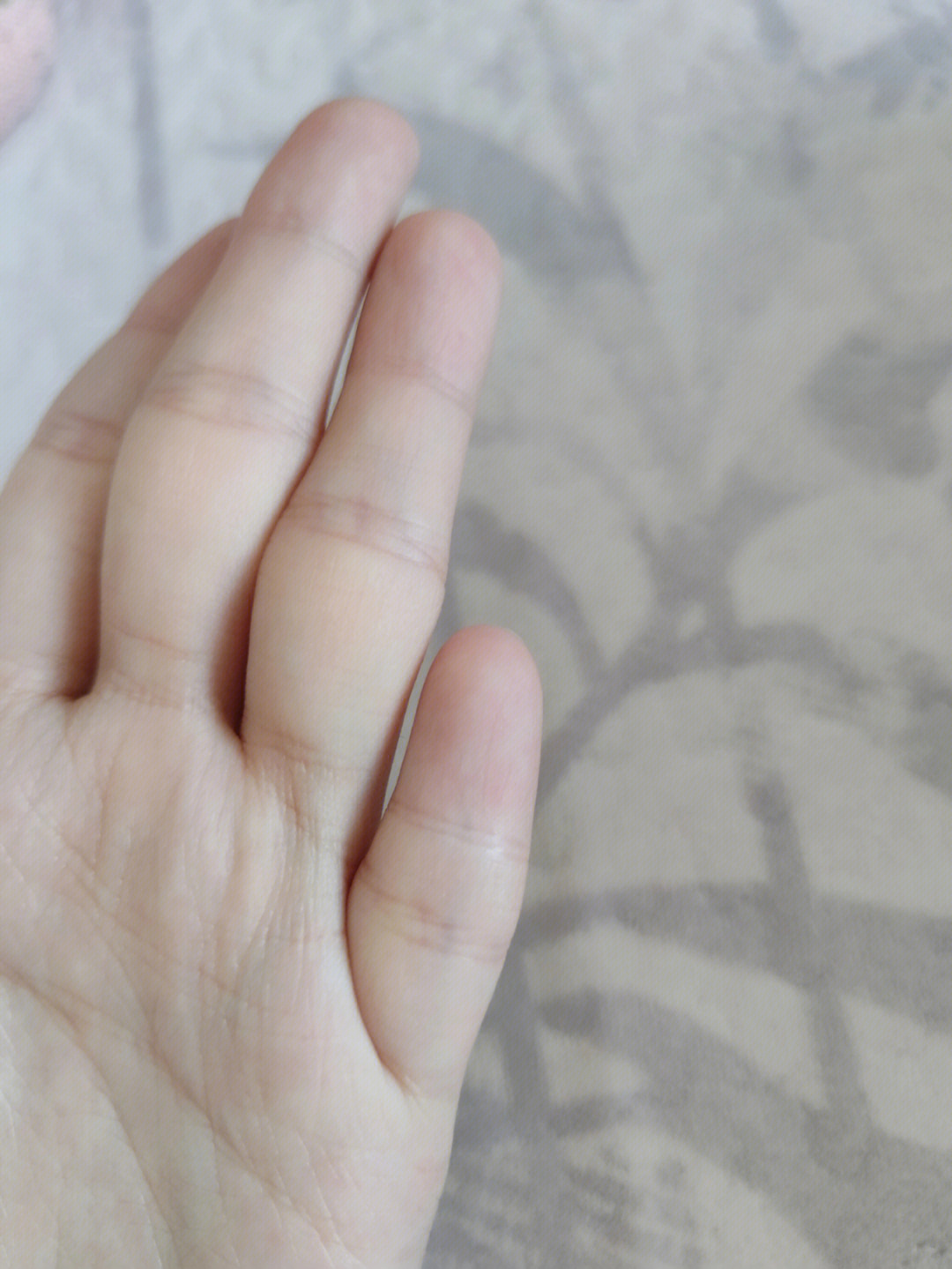 握拳后关节是瘪的,没有其他手指那种突出的关节.
