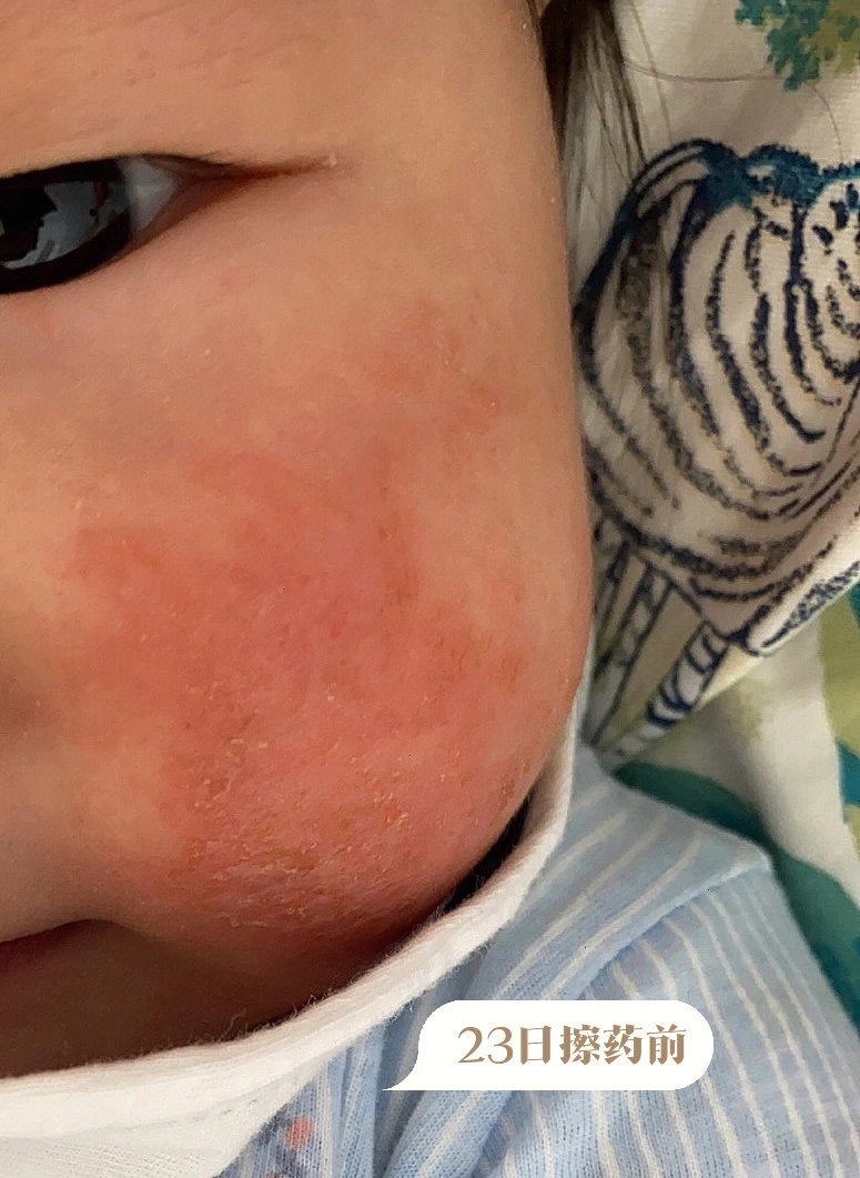 婴儿胸前湿疹图片图片