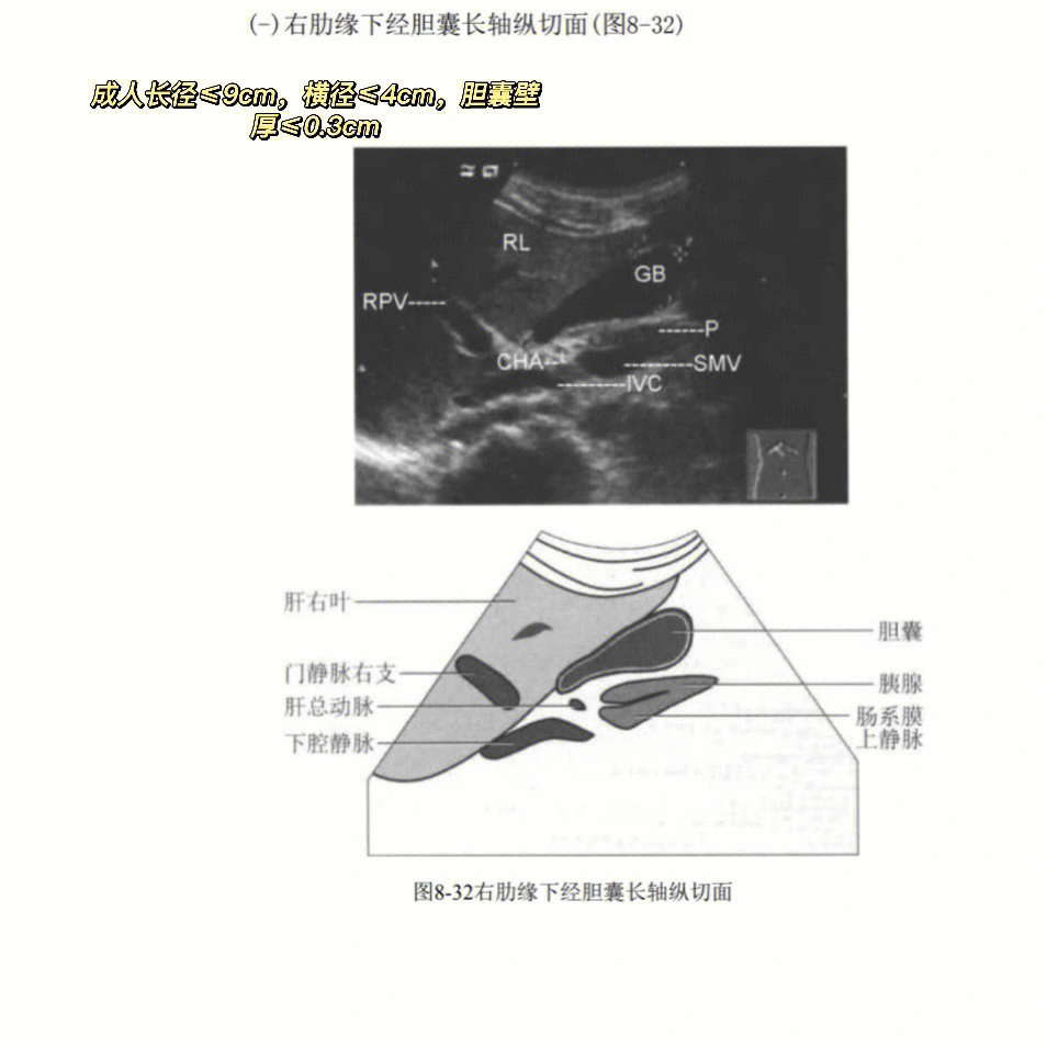 胆囊正常切面图#超声#学习打卡#b超检查