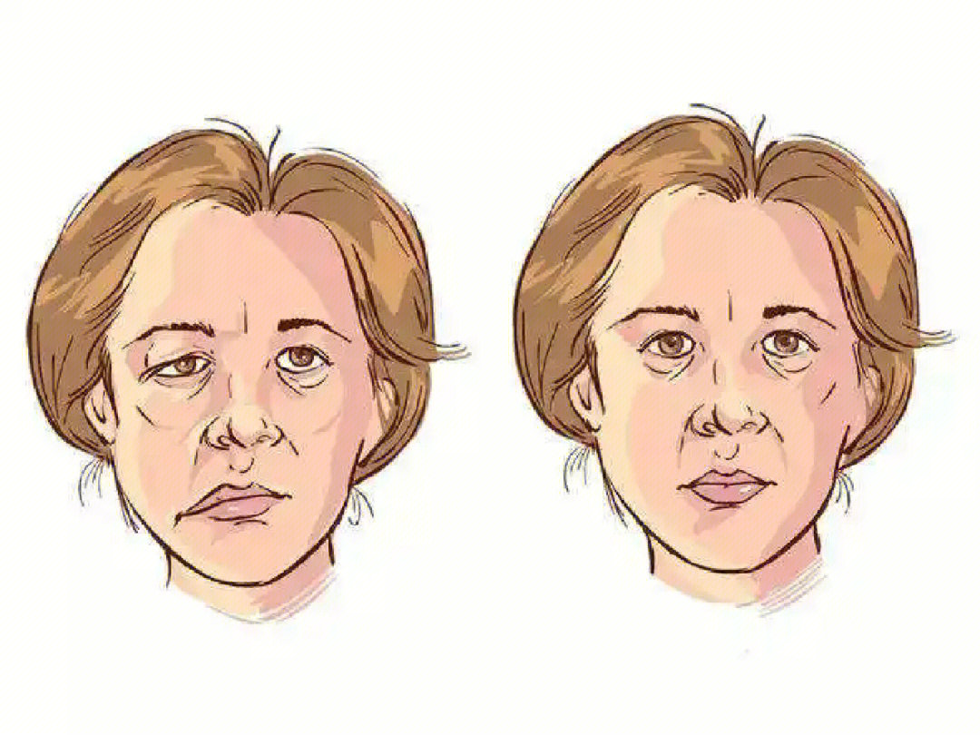 面瘫分为中枢性面瘫和周围性面瘫