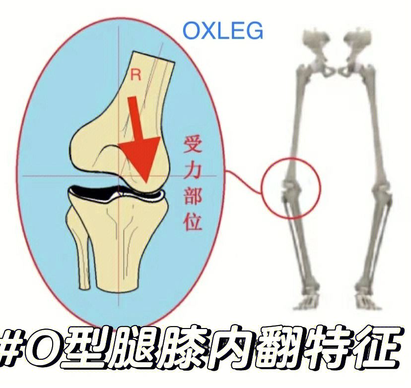 O型腿是怎么形成的图片