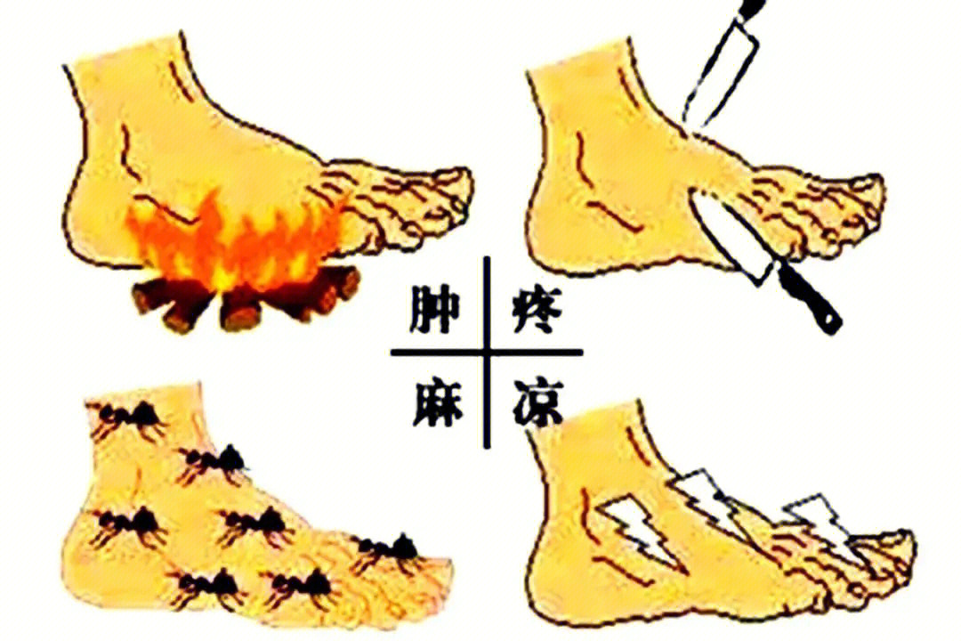 糖尿病神经病变症状图片