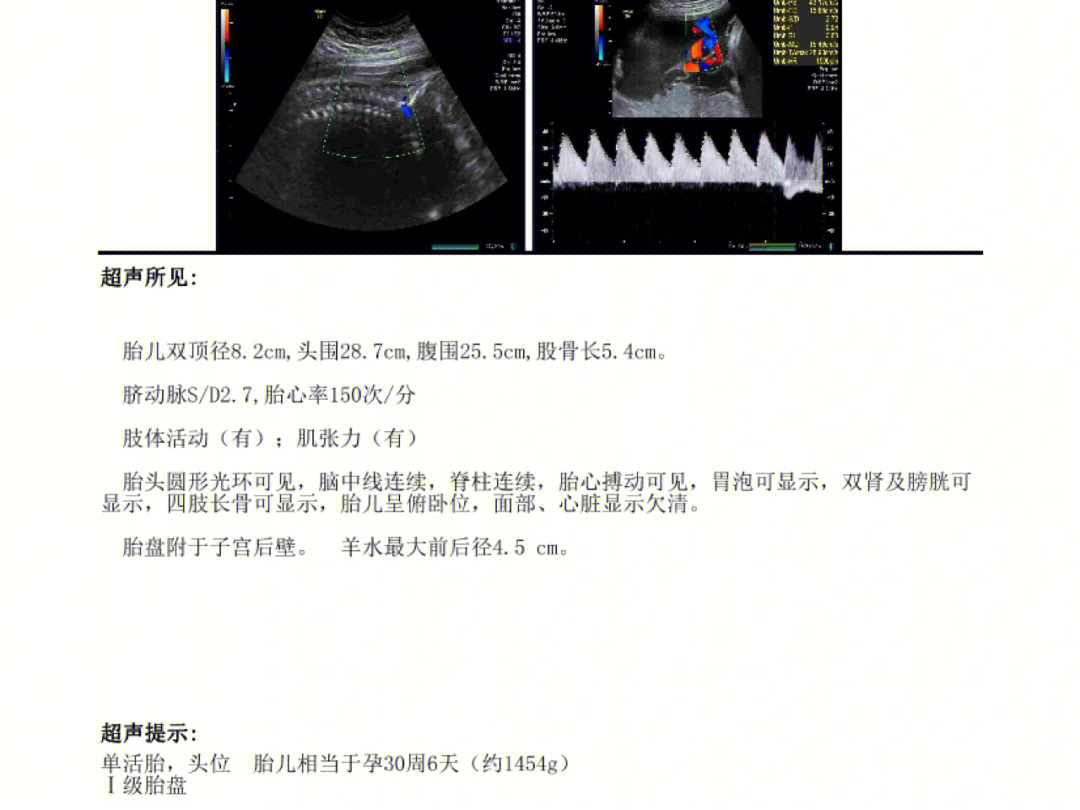 更新:今天去产检医生说这些数据都在正常范围内,侧脑室也是正常值,不