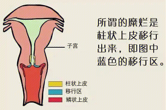 提问宫颈糜烂到底是不是病