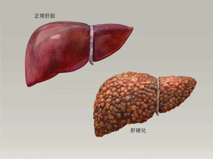 血吸虫性肝硬化图片