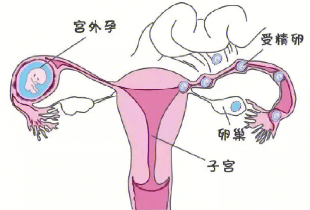 宫外孕的症状图片
