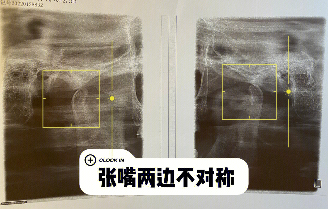 颞下颚关节紊乱口腔平扫