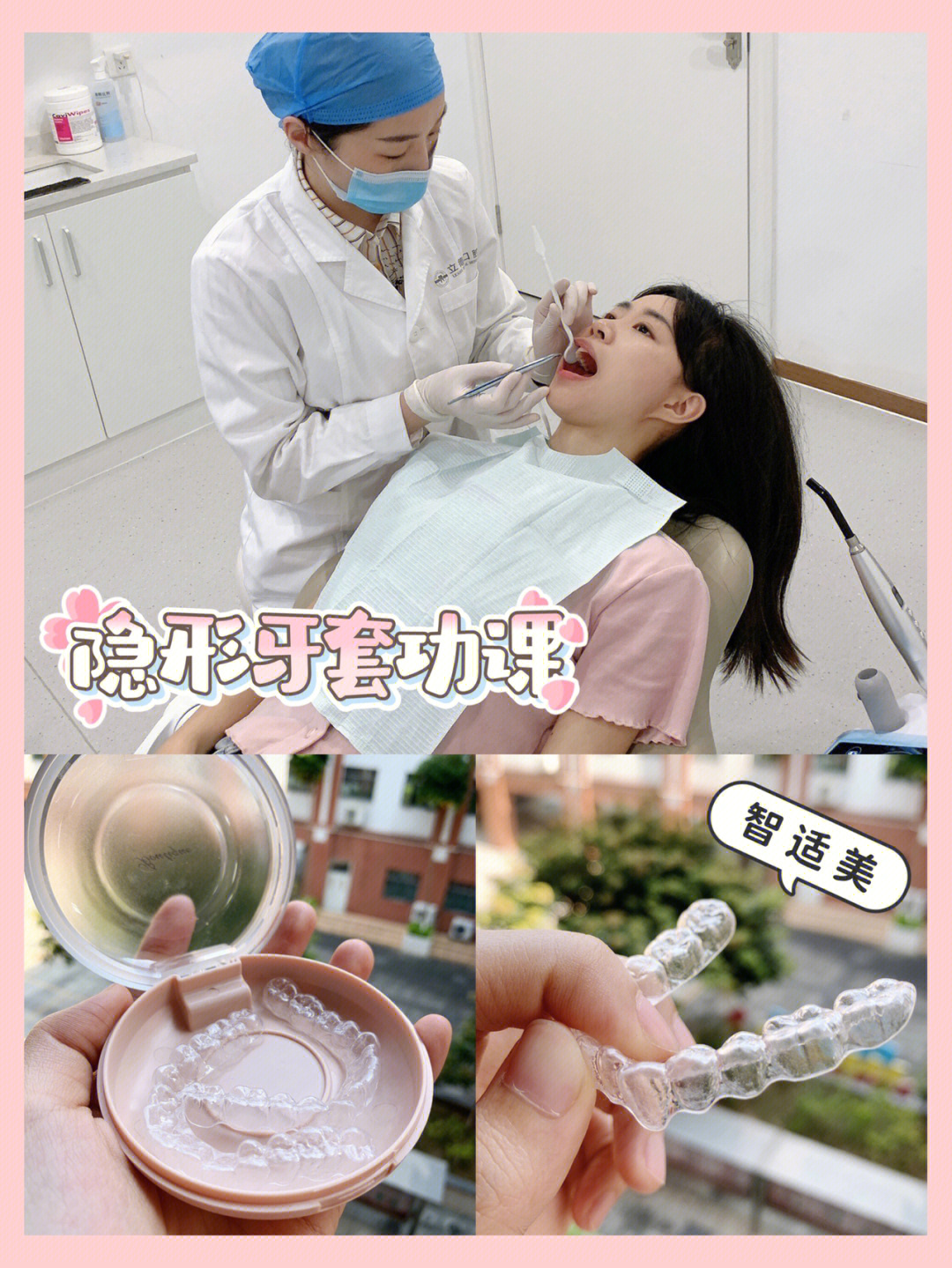 隐形牙套收牙缝过程图图片